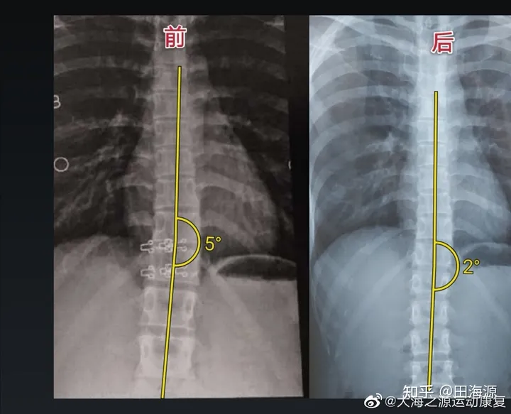 脊柱侧弯大全集一篇搞定(图10)