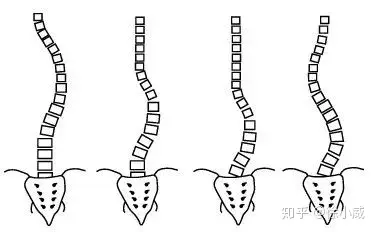 脊柱侧弯详解以及治疗方法(图2)