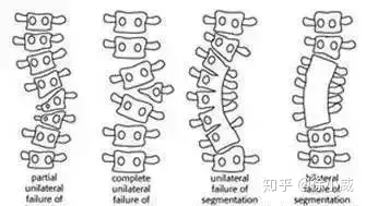 脊柱侧弯详解以及治疗方法(图3)