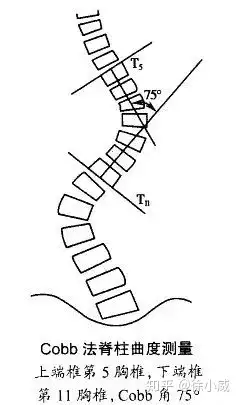 脊柱侧弯详解以及治疗方法(图9)
