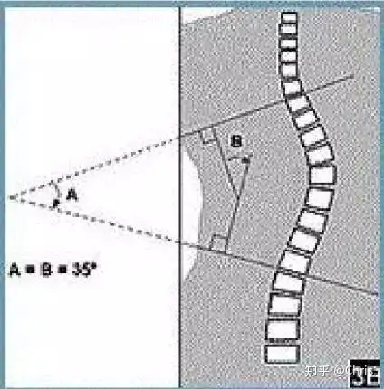 彻底了解脊柱侧弯(图9)