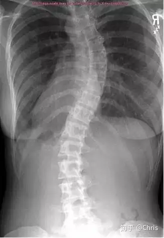彻底了解脊柱侧弯(图8)