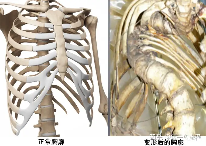 了解脊柱侧弯(图8)