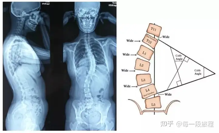 了解脊柱侧弯(图12)