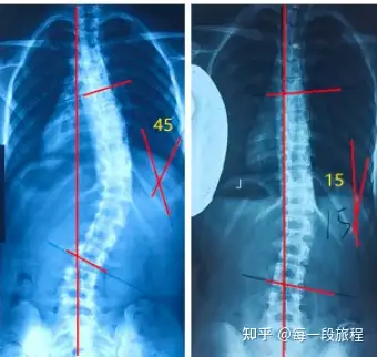 了解脊柱侧弯(图15)