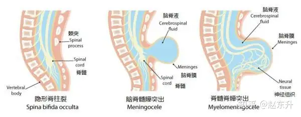 脊柱裂是什么病？大小便障碍该怎么治疗？(图1)