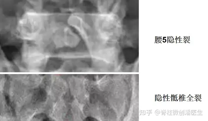 拍片发现隐性脊柱裂是骨折了吗？需要手术吗？(图2)