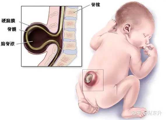 脊柱裂是什么病？大小便障碍该怎么治疗？(图2)