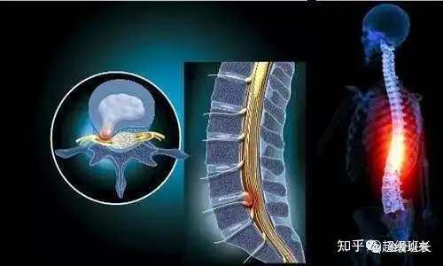 腰椎间盘突出症诊断方案及治疗方法（完整版）(图1)