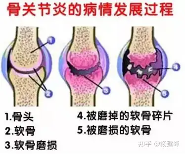 关节炎(图2)