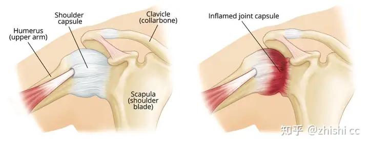 肩周炎是怎么回事，自己可以做什么？(图2)