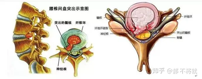 什么是腰间盘突出？(图3)