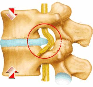 什么是腰间盘突出？(图5)
