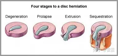 腰椎间盘突出了，你会怎么办？(图1)