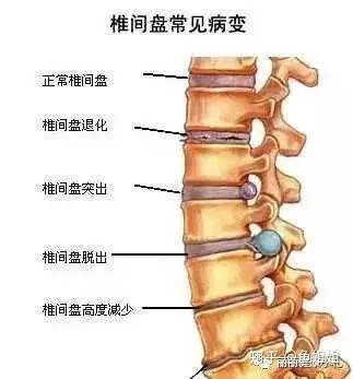 带你了解腰椎间盘突出症(图2)