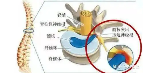 什么是腰椎间盘突出，腰间盘突出怎么治疗比较(图2)