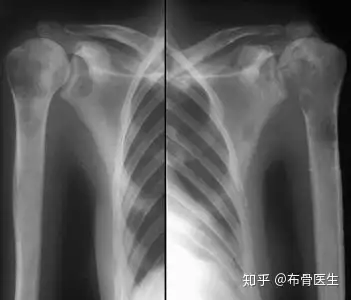 您了解骨肿瘤吗？为您深层解析关于骨肿瘤的那(图4)