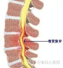 一口气读懂骨结核病，关于骨结核，你想知道的(图4)