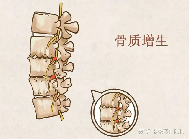 骨质增生的原因？(图1)