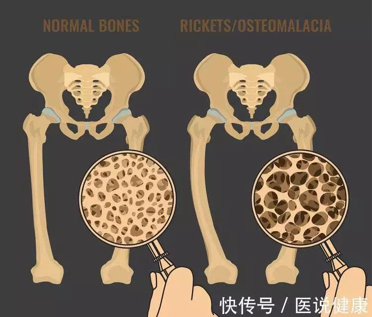 查出骨质增生，治疗时有3个途径了解后，才能对(图1)