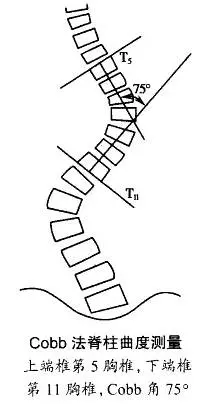 脊柱侧弯纠正大法（多图详解，赶紧转走！）(图1)