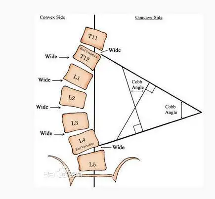 【脊柱康复】脊柱侧弯怎么办？(图1)