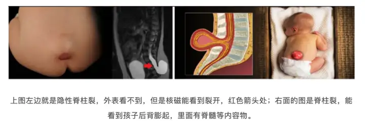 屁股长“头发”，除了隐性脊柱裂，你还知道其(图2)