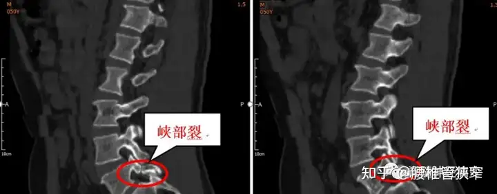 腰椎峡部裂到底如何有效治疗？(图1)