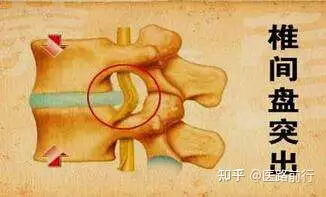 怎么样预防腰间盘突出？(图1)