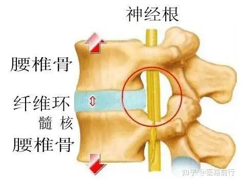 怎么样预防腰间盘突出？(图2)