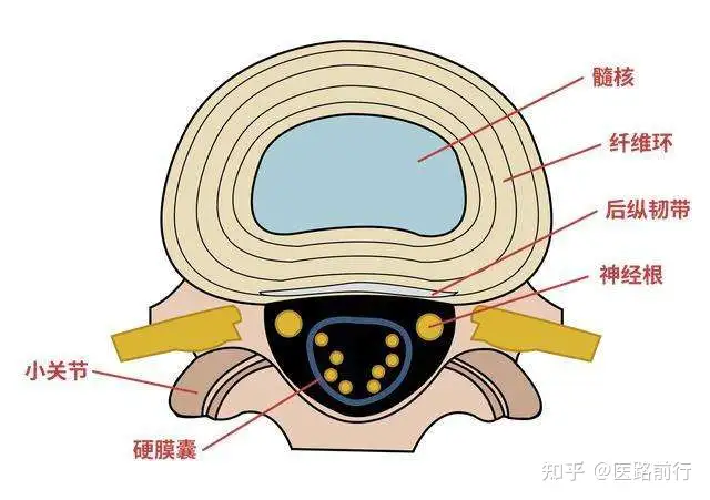 怎么样预防腰间盘突出？(图3)