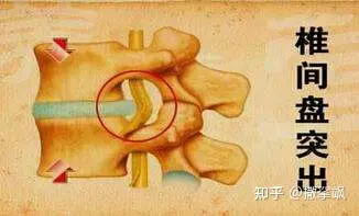 怎样才能预防腰椎间盘突出症(图2)