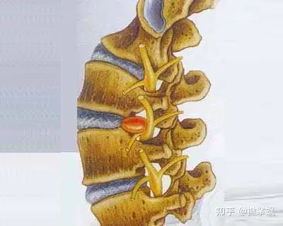 怎样才能预防腰椎间盘突出症(图1)