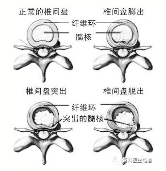 脊椎问题人人都有？腰突到底如何预防？学会这(图1)