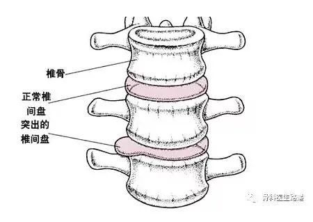 脊椎问题人人都有？腰突到底如何预防？学会这(图2)