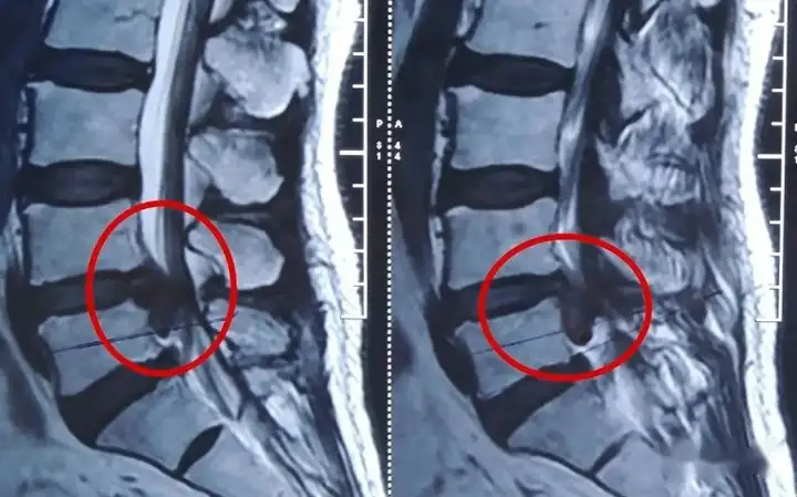 腰间盘突出最佳治疗，这几种方法一定要知道！(图2)