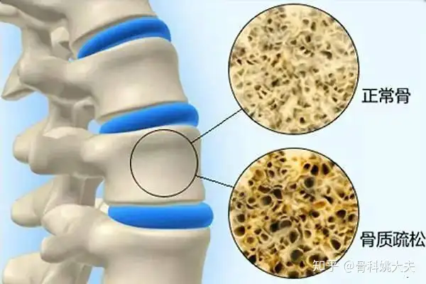 骨质疏松怎么治疗？骨质疏松应该吃啥药？这里(图1)