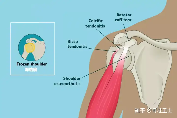 肩周炎的预防措施到底是有哪些？(图2)