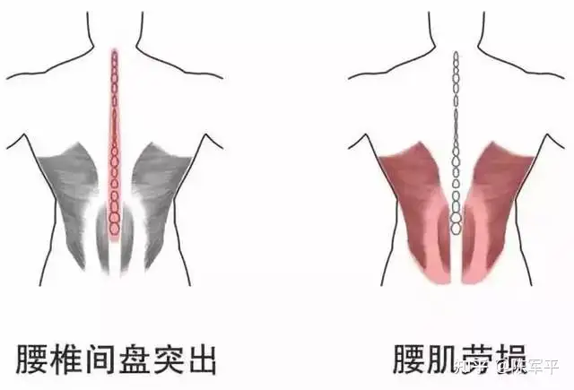 如何预防腰肌劳损？(图11)