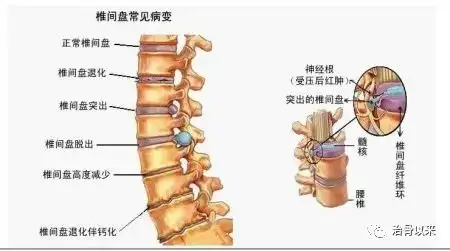 腰间盘突出断根秘方，根治多年的腰间盘突出(图1)