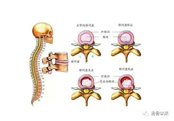 唯一一个治腰突的秘方，十天治好腰椎间盘突出(图1)