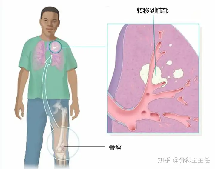 骨癌有哪些表现？致病原因是什么？该如何预防(图1)