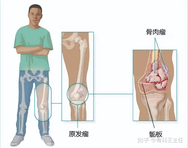 骨癌有哪些表现？致病原因是什么？该如何预防(图3)