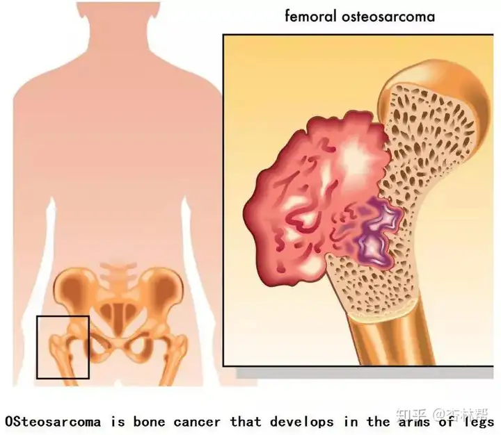 什么是骨肉瘤？该怎么治疗？——刘建湘骨肿瘤(图2)