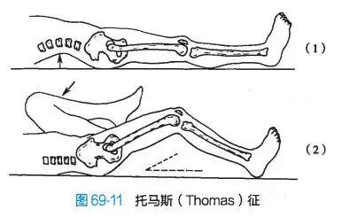 骨与关节结核（笔记）(图7)