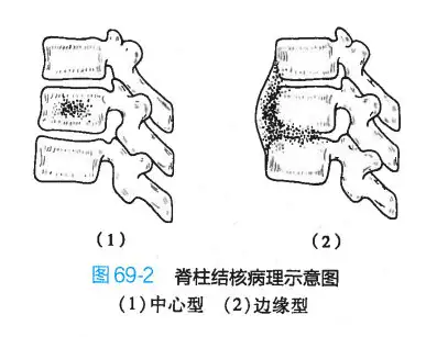 骨与关节结核（笔记）(图3)