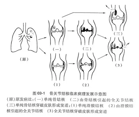 骨与关节结核（笔记）(图2)