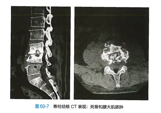 骨与关节结核（笔记）(图6)