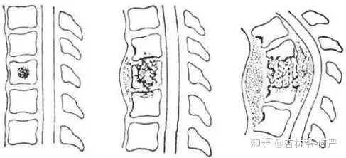 脊柱结核怎么办，吃药还是手术？——骨科专家(图2)