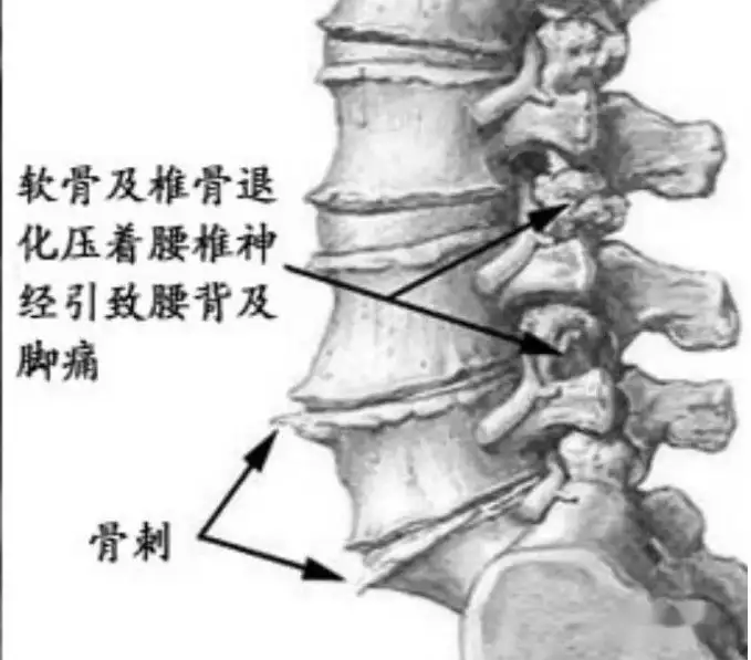 骨刺特效方,各种骨质增生特效根治秘方千万别错(图3)